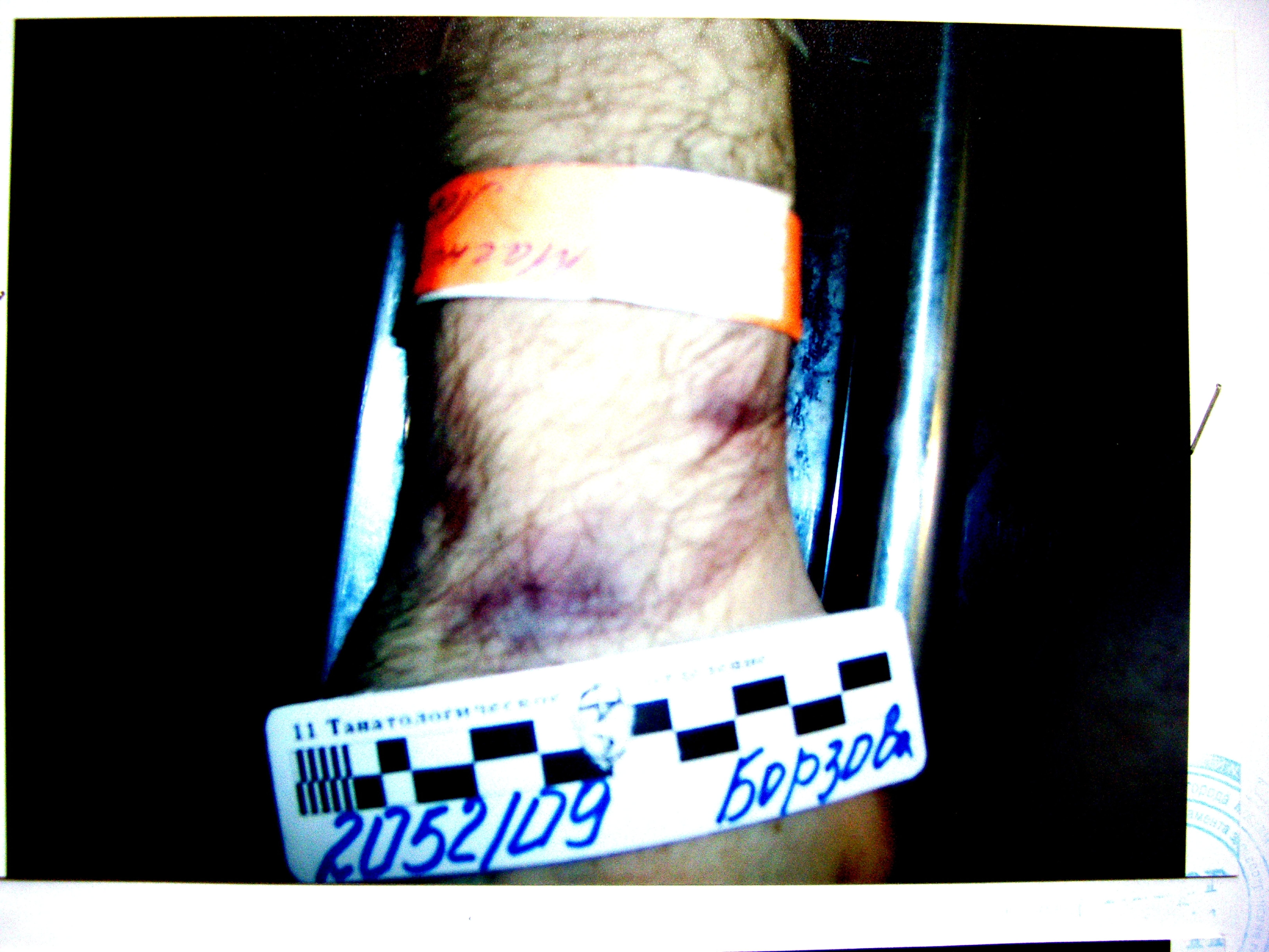 Photos from Nov 17, 2009 Borzova Report No2052 wrist & knee bruises